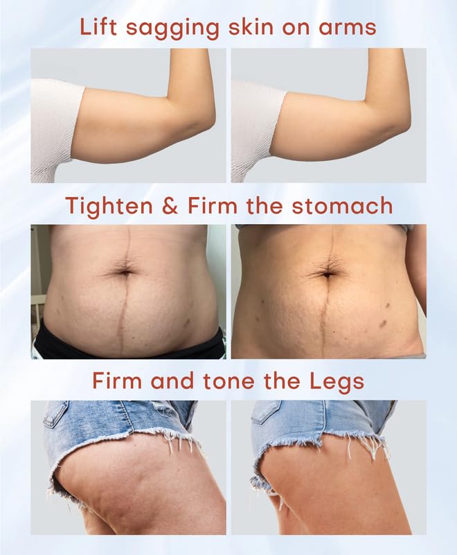 Open-Box New MLAY Professional RF Skin Tightening Machine - 2 Probes Anti-Aging