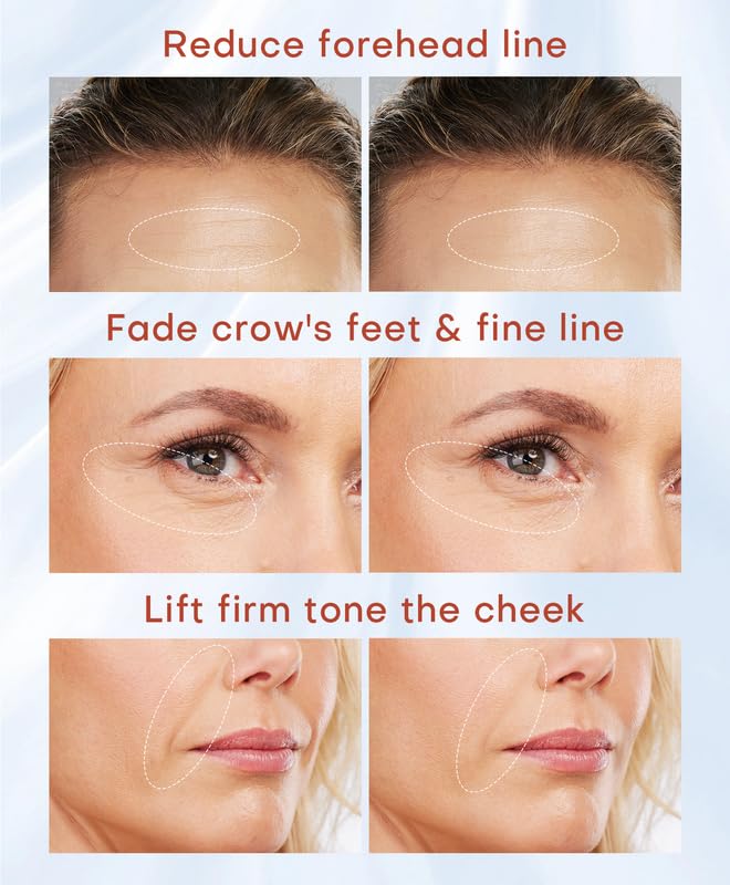 Open-Box New MLAY Professional RF Skin Tightening Machine - 2 Probes Anti-Aging